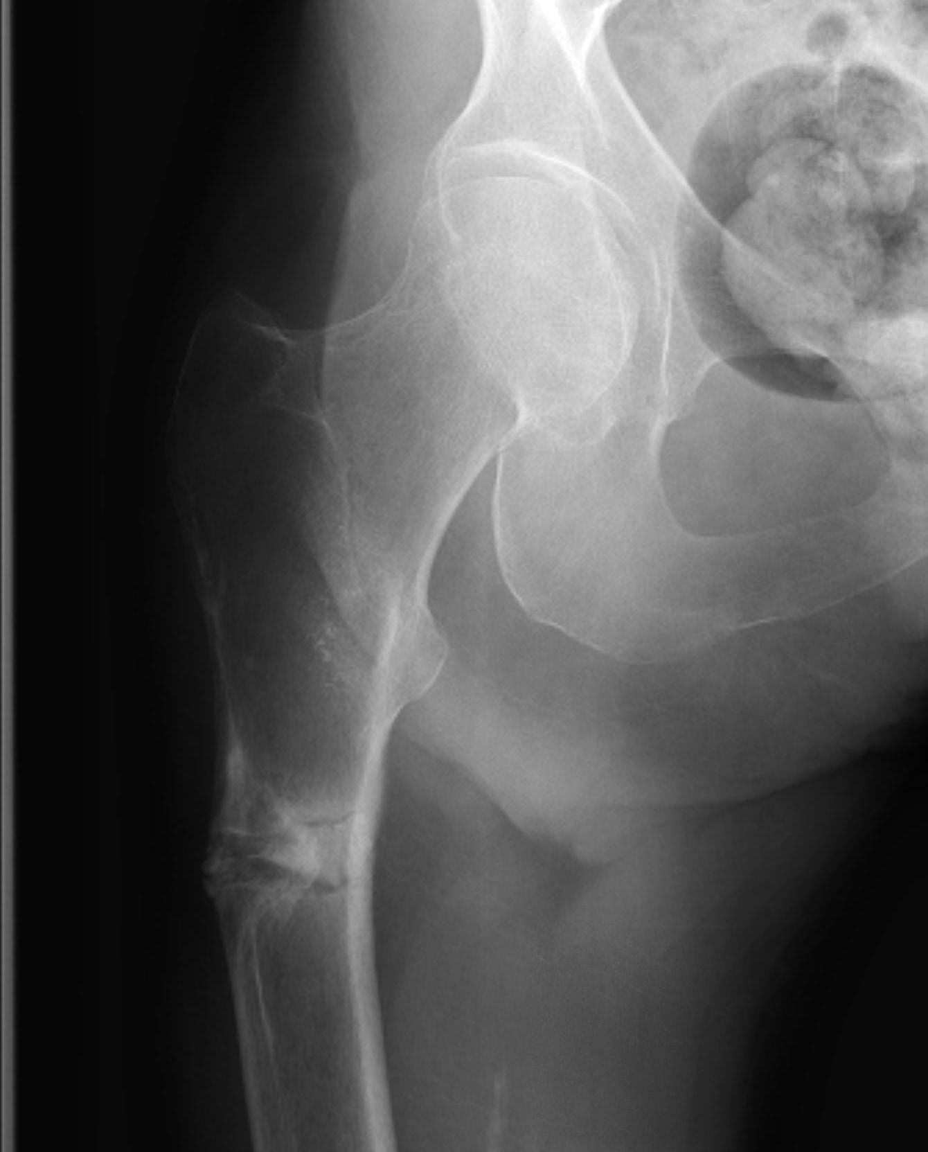 Femoral stress fracture